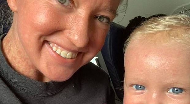 Mamma e figlio di un anno cacciati dall’aereo per una malattia genetica della pelle